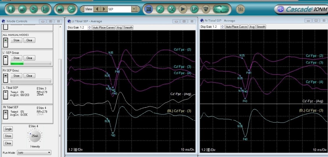 誘發電位監測1