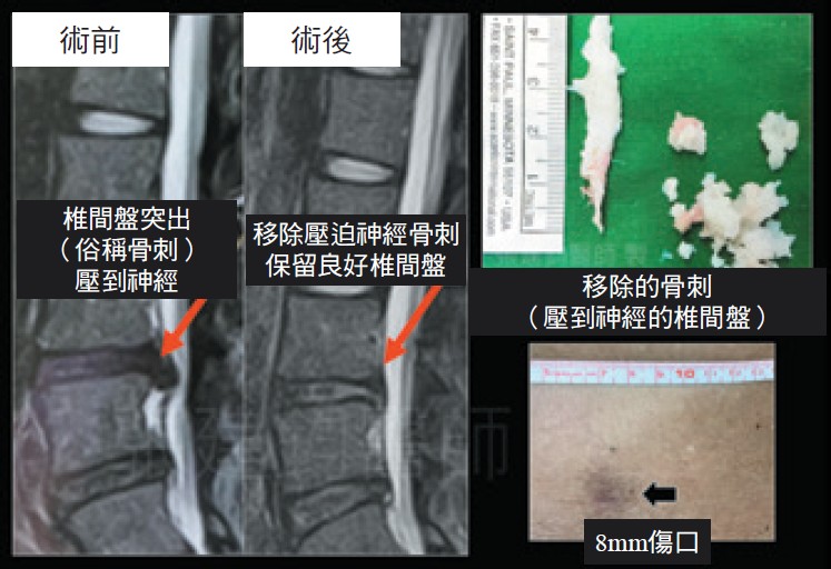 新式脊椎內視鏡微創手術治療