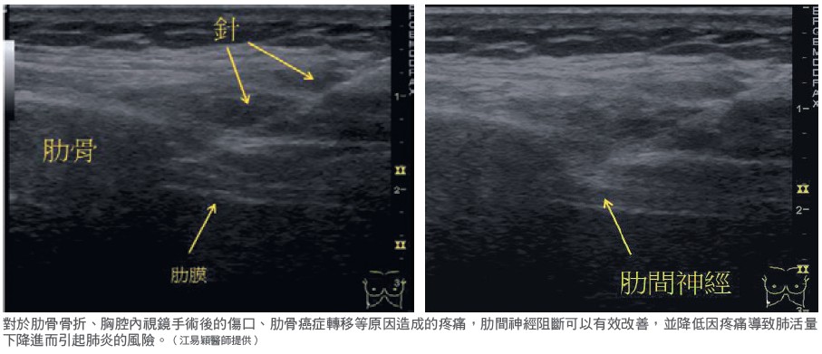 對於肋骨骨折、胸腔內視鏡手術後的傷口、肋骨癌症轉移等原因造成的疼痛