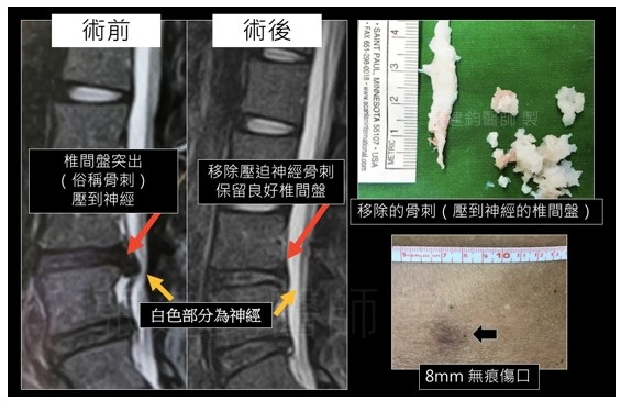 微創脊椎手術新選擇：脊椎內視鏡手術演進和介紹