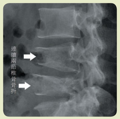 連續兩節椎骨骨折