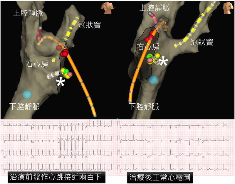 三維導航完成零輻射心導管手術治療心律不整